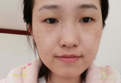 激光祛斑视频全过程,安全高效，美丽蜕变